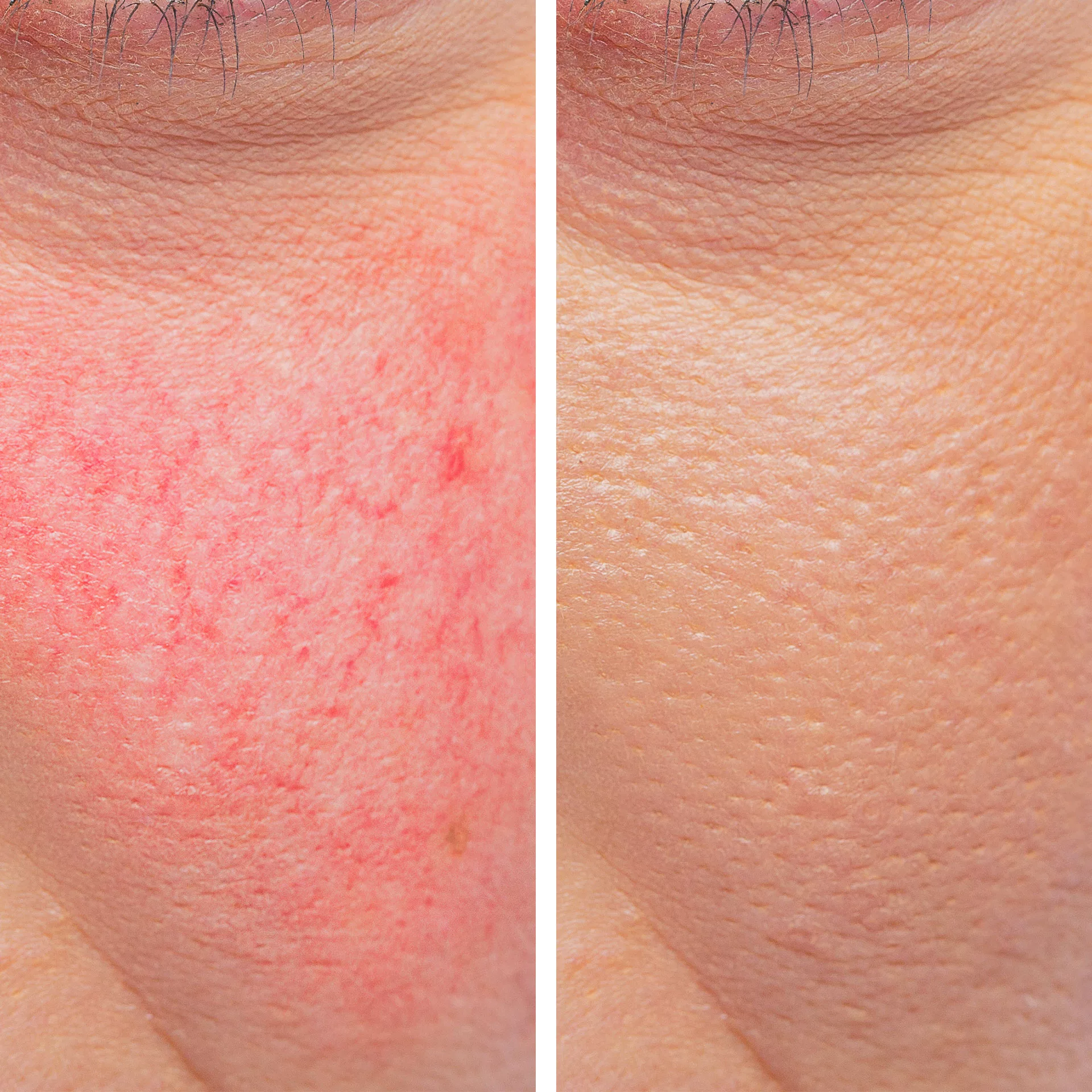 Spider veins on skin before and after treatment